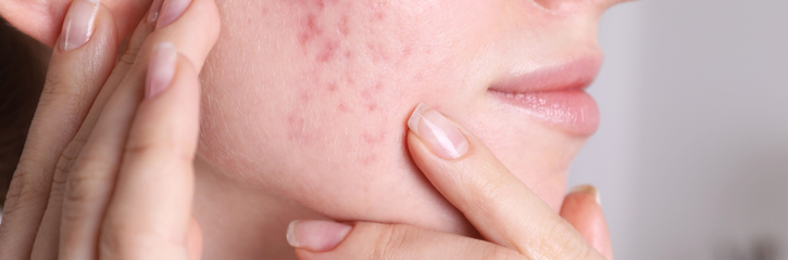 從痘疤困擾到匿齡光采，掌握肌膚問題「對症下藥」才是關鍵